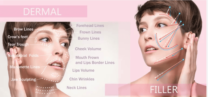 Dermal Fillers