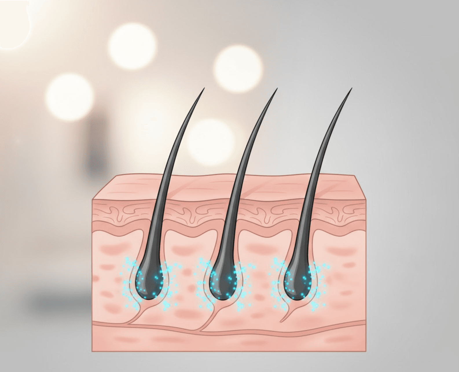 Dutasteride Mesotherapy for Hair loss