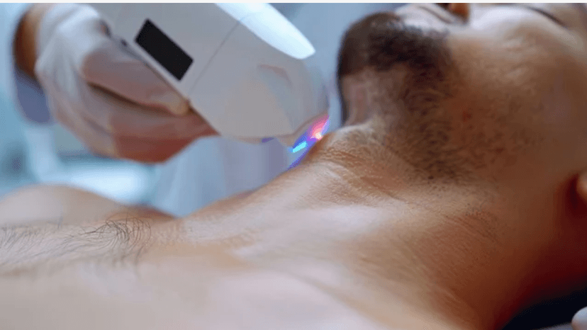 Neck (Front or Back) Laser Hair Removal