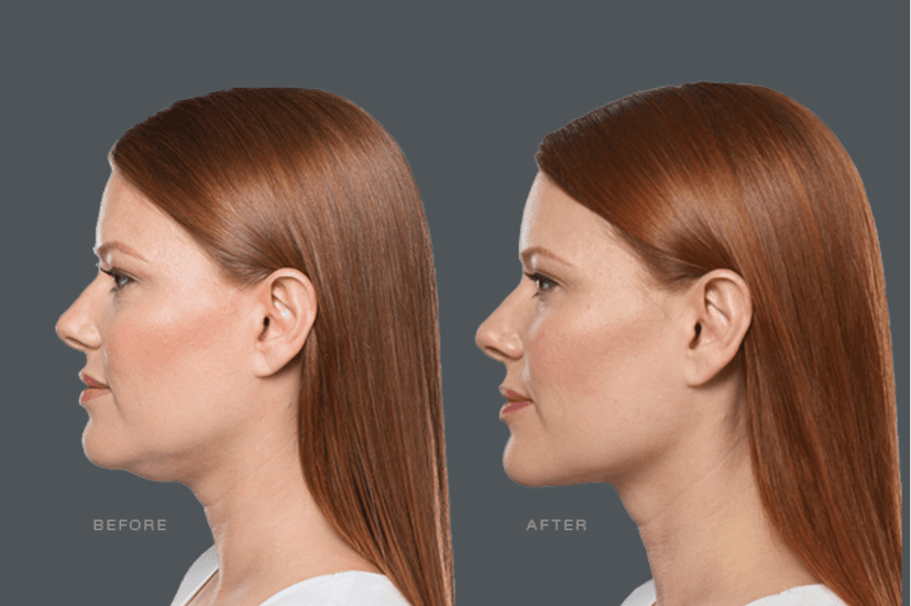 Kybella